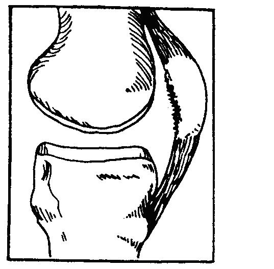 kneearthroscopy-6_patella