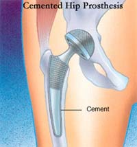 totalhipreplacement_5