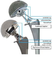 totalhipreplacement_7