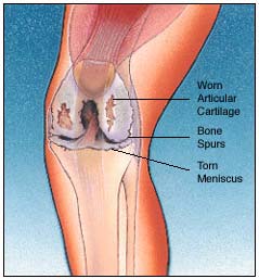 totalkneereplacement_2