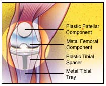 totalkneereplacement_4