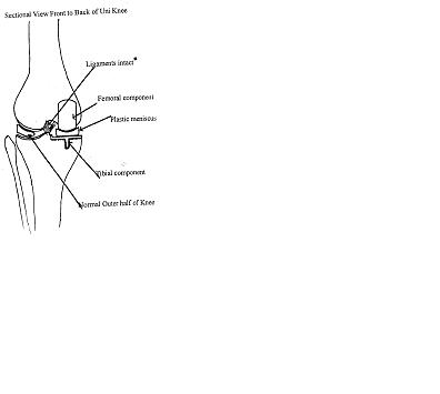 unicompartmentalkneereplacement_3